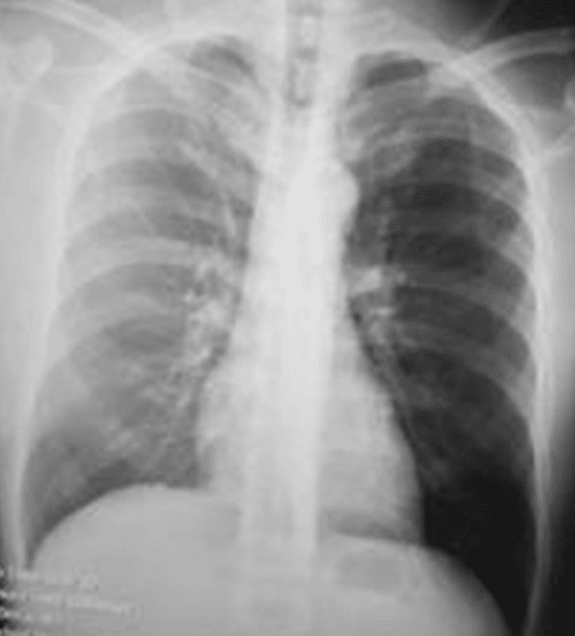 Intususcepción ileo-cecal Radiografía tele de tórax normal